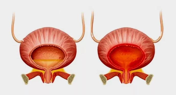 Vexiga normal (esquerda) e inflamación da vexiga con cistite (dereita)